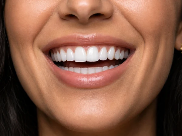 Forfait Hollywood Smile Signature — 18 Facettes E-Max
