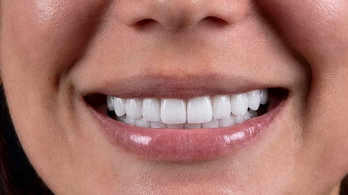 Après facettes dentaires Tunisie — sourire blanc uniforme Hollywood Smile