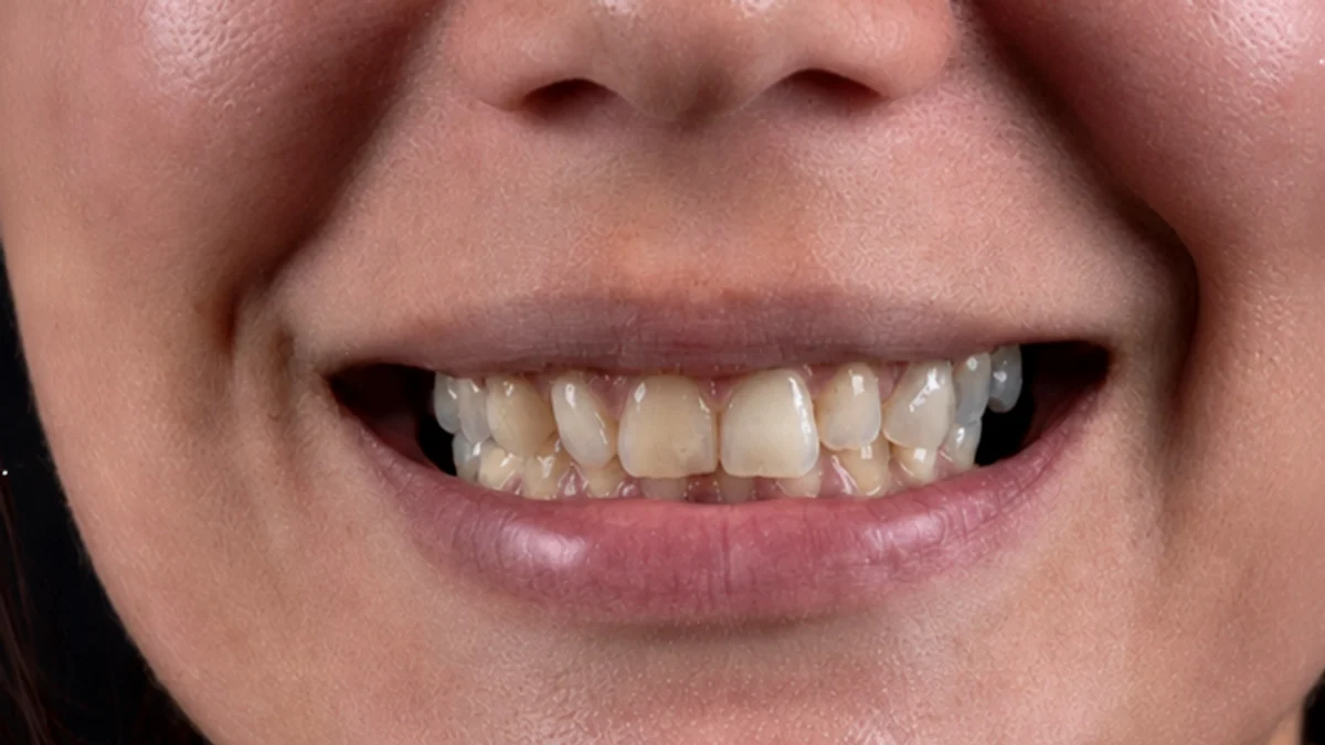 Avant facettes dentaires Tunisie — sourire irrégulier dents jaunâtres