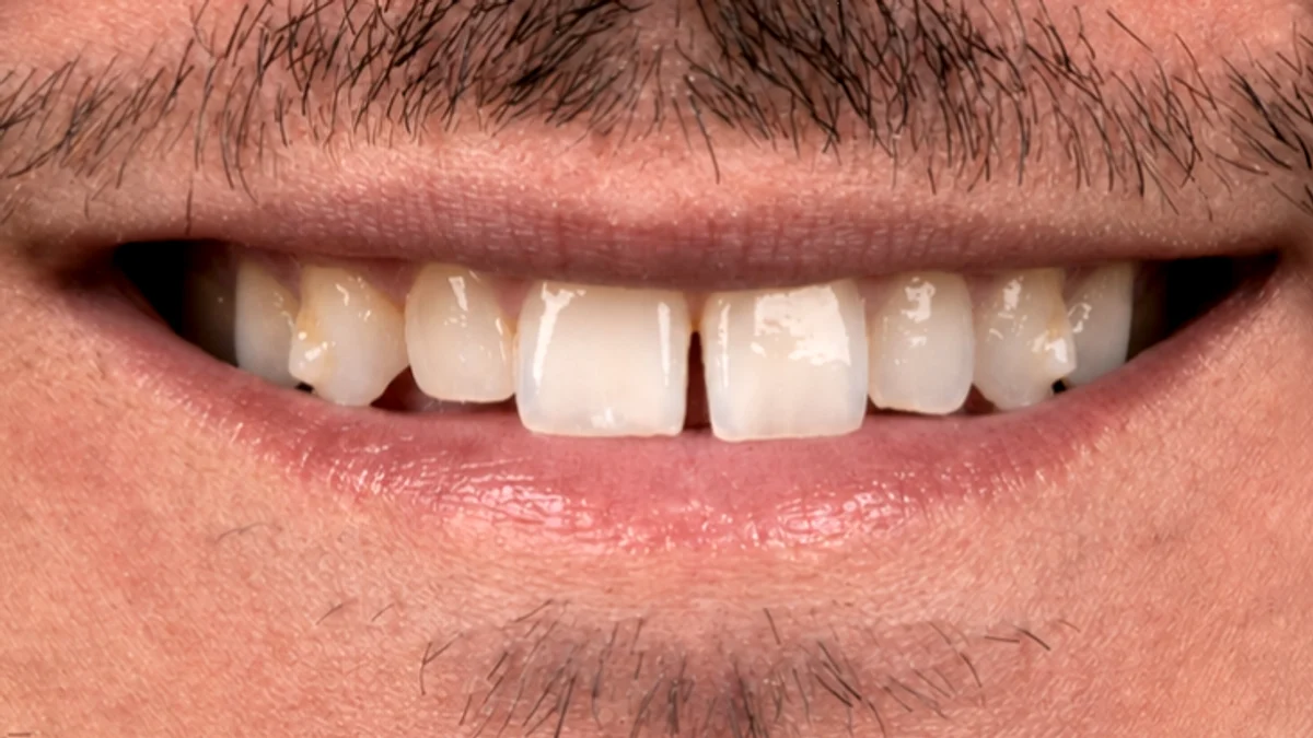 Avant facettes E-Max IPS Ivoclar — bouche dents abîmées