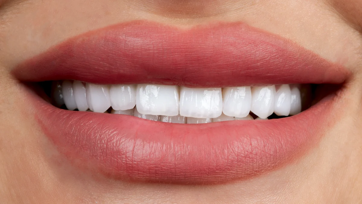 Après Hollywood Smile Tunisie — sourire éclatant facettes dentaires céramique