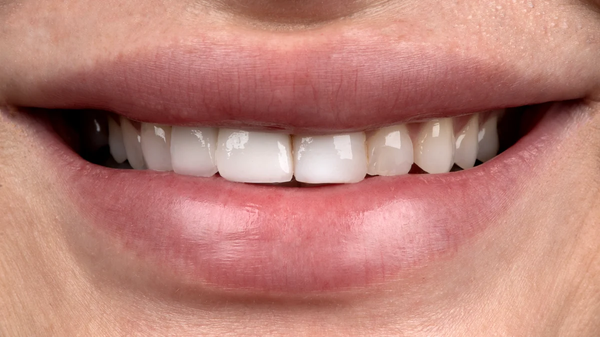 Avant Hollywood Smile Tunisie — sourire à transformer facettes dentaires